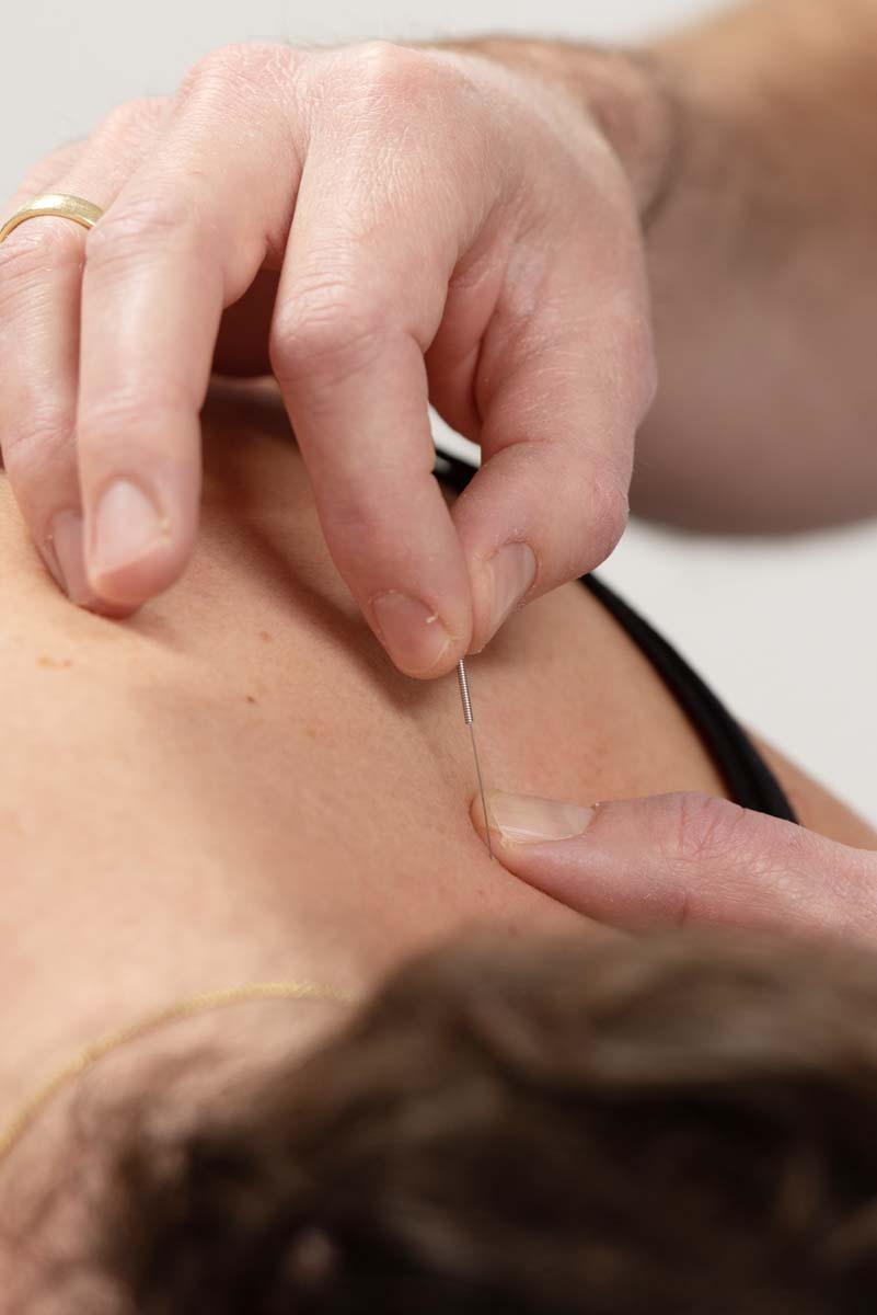 fysant-fysiotherapie-dry_needling